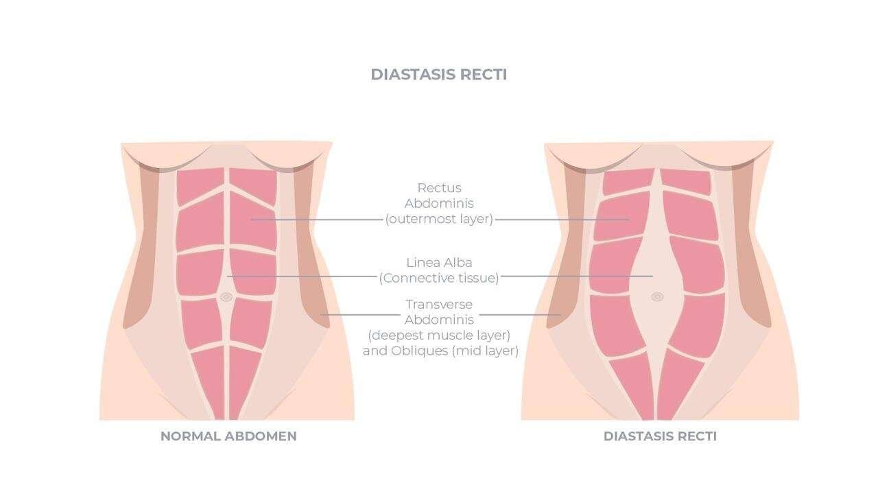 Diastasis Recti: The Core Connection