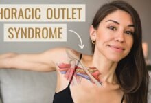 Thoracic Outlet Syndrome Exercises - bestknock.com