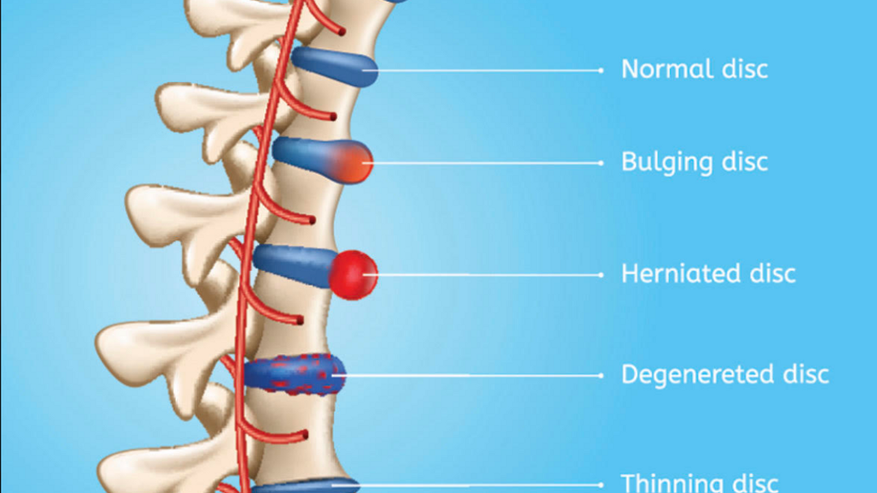 Herniated Disc - Lower back pain when bending over - bestknock.com