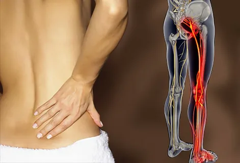 Sciatica - Lower Back Pain When Running - bestknock.com