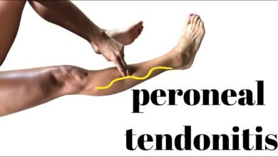 Peroneal Tendonitis